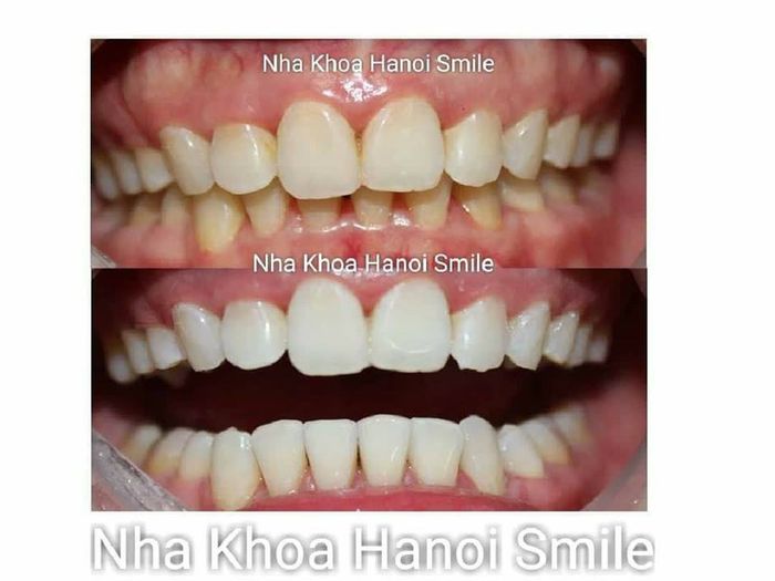 Hình ảnh 1 – NHA KHOA HANOI SMILE