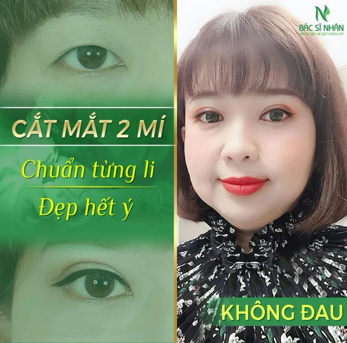 Hình ảnh thực tế về những đôi mắt đẹp tựa thiên thần tại Thẩm Mỹ Viện BS Nhân