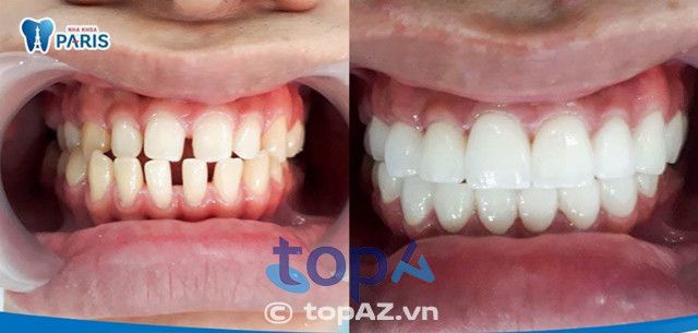 Đâu là địa chỉ bọc răng sứ chất lượng nhất Hà Nội?