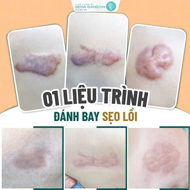 Địa chỉ trị sẹo uy tín tại Tiền Giang