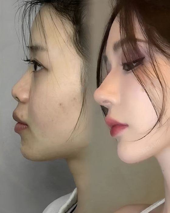 Noselab - Phòng Khám Chuyên Nâng Mũi ảnh 2