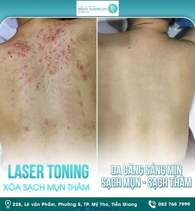 Địa chỉ trị thâm sẹo hiệu quả tại Tiền Giang