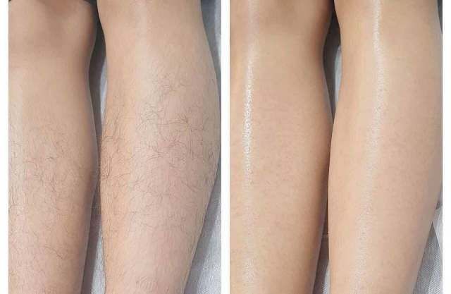 Én Spa – Địa chỉ triệt lông uy tín tại TPHCM
