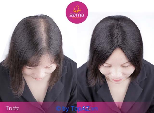 Khám phá địa chỉ trị rụng tóc hiệu quả và uy tín nhất tại TP.HCM
