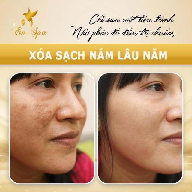 Én Spa – Địa chỉ trị nám uy tín hàng đầu tại Quận 9