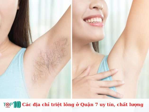 Các địa chỉ triệt lông uy tín tại Quận 7, chất lượng vượt trội