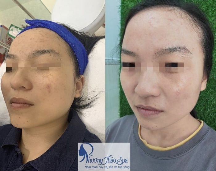 Phương Thảo Spa - Hình ảnh thực tế về quy trình trị liệu da chuyên nghiệp