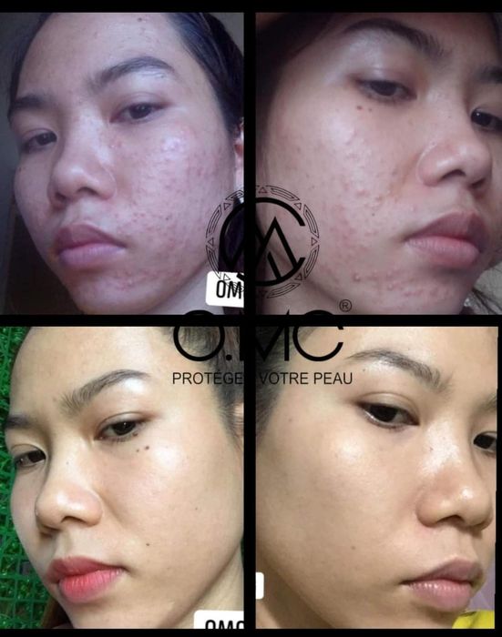 Hình ảnh quy trình chăm sóc da chuẩn y khoa tại Nàng Spa