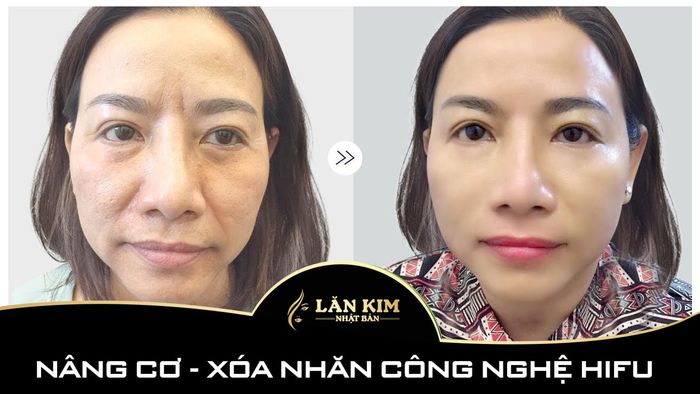 Lăn Kim Nhật Bản - Hình ảnh thực tế về quy trình chăm sóc da chuyên nghiệp
