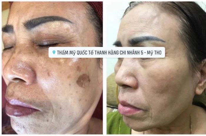 Hình ảnh quy trình thẩm mỹ chuyên nghiệp tại Thanh Hằng