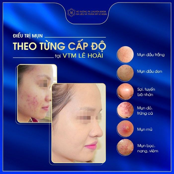 Hình ảnh thực tế về quy trình điều trị da chuyên nghiệp tại Viện Thẩm Mỹ Lê Hoài