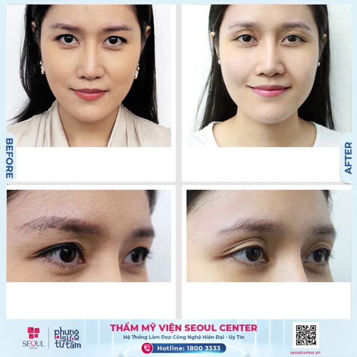 Hình ảnh quy trình xóa xăm chuyên nghiệp tại Thẩm Mỹ Viện Seoul Center