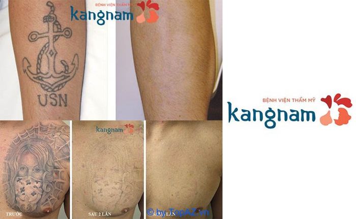 xoá hình xăm không sẹo hà nội