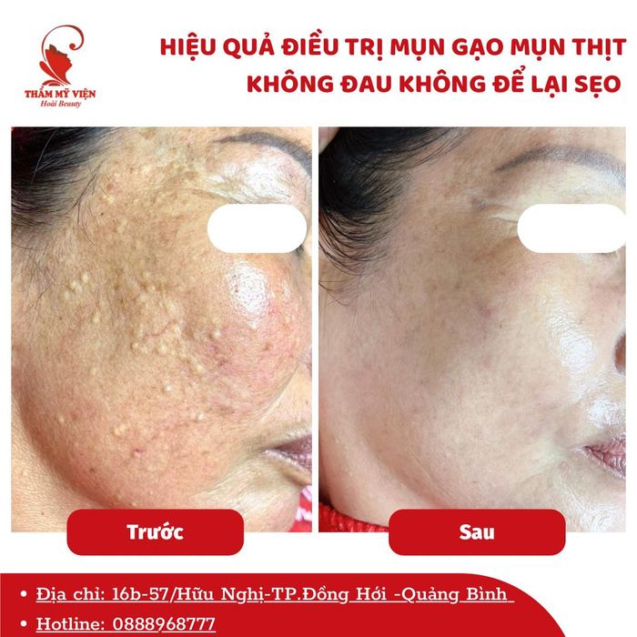 Hình ảnh liệu trình chăm sóc da tại Hoài Beauty & Spa