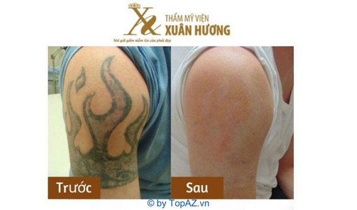 Địa chỉ xóa hình xăm uy tín tại Hà Nội