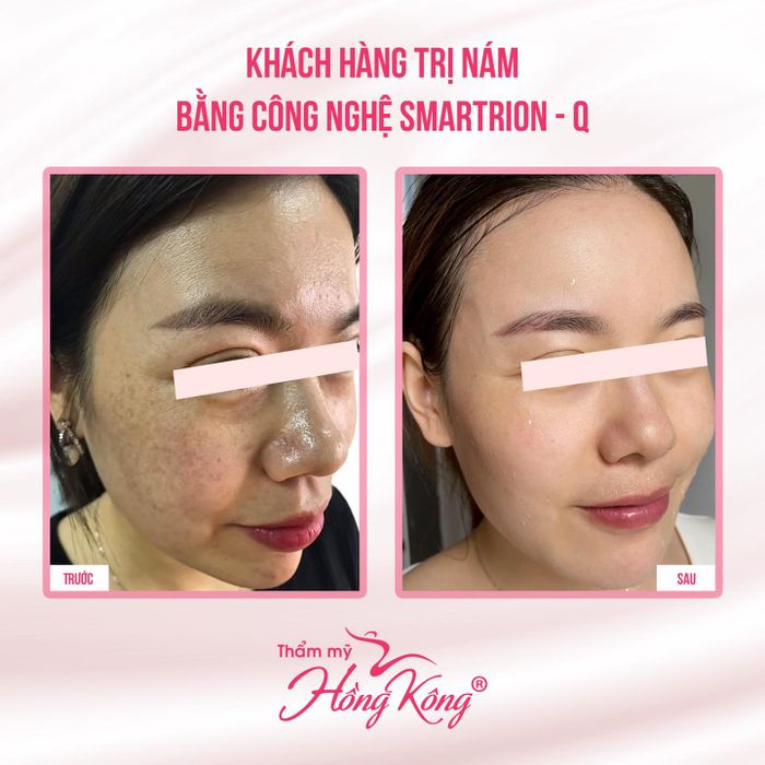 Quy trình thẩm mỹ chuẩn 5 sao tại Thẩm mỹ Hồng Kông