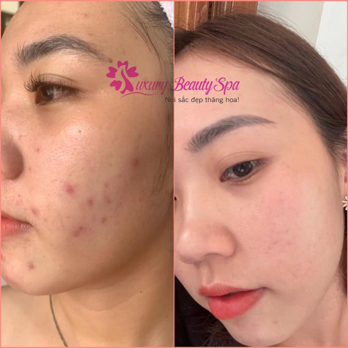 Hình ảnh trị liệu chuyên nghiệp tại Luxury Beauty Spa Quy Nhơn