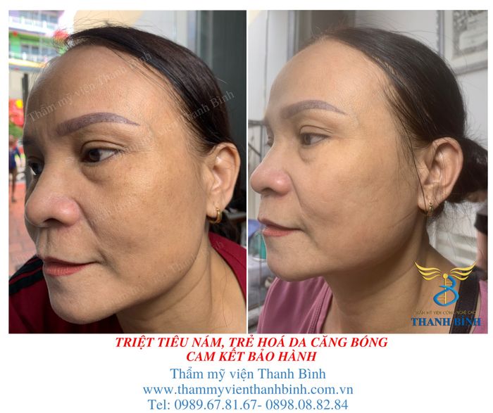 Quy trình điều trị da chuẩn y khoa tại Thẩm mỹ viện Thanh Bình