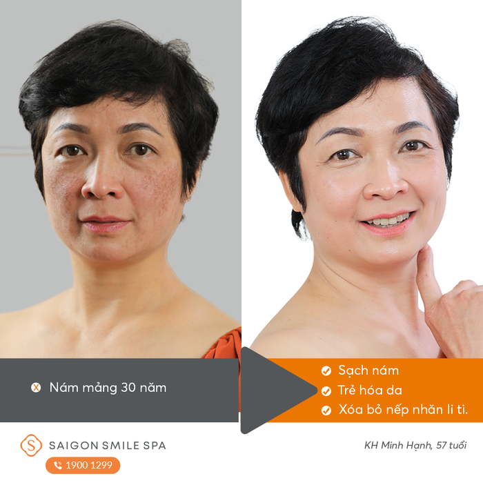 Ảnh minh họa của Saigon Smile Spa