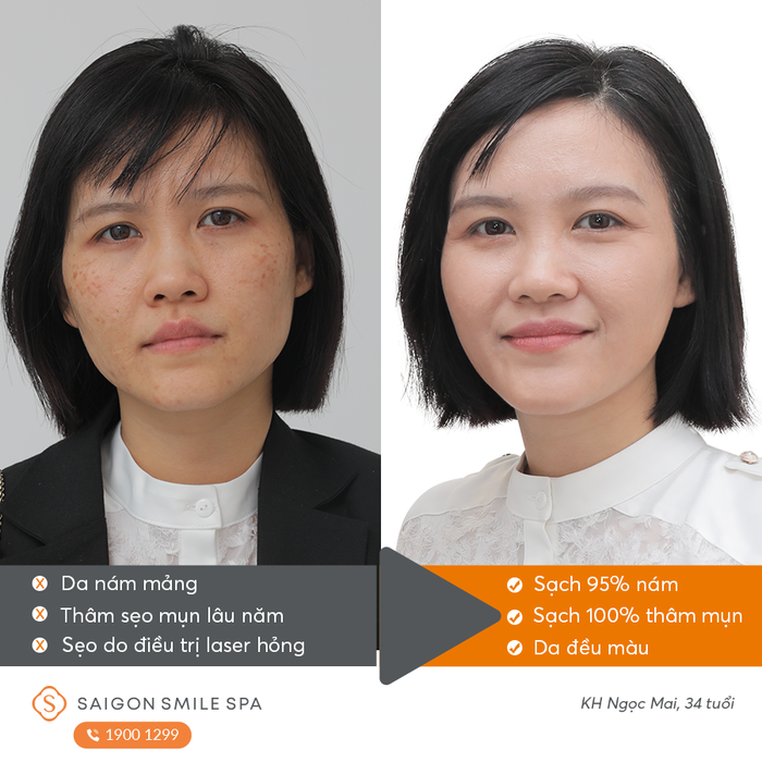 Ảnh minh họa của Saigon Smile Spa