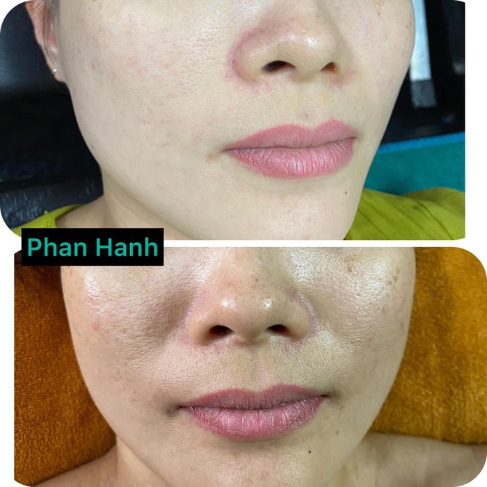 Trải nghiệm dịch vụ chăm sóc da cao cấp tại Hạnh Phan Beauty & Clinic