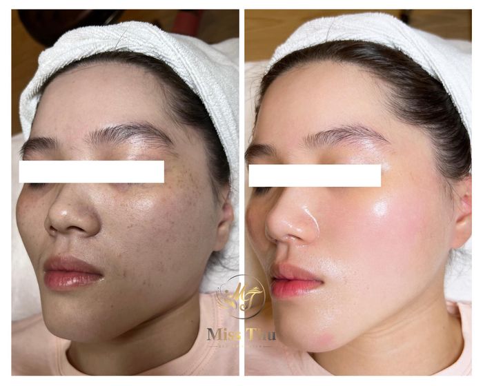 Hình ảnh quy trình chăm sóc da chuyên nghiệp tại Viện Thẩm Mỹ MISS THU
