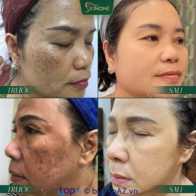 Phòng khám chuyên khoa da liễu SkinOne tại TPHCM