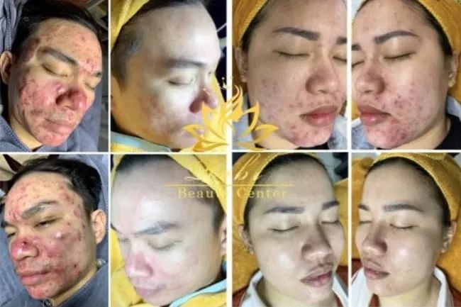 Kết quả ấn tượng sau liệu trình tại Rebi Beauty Spa: Làn da sạch mụn, sáng khỏe và mịn màng bền vững