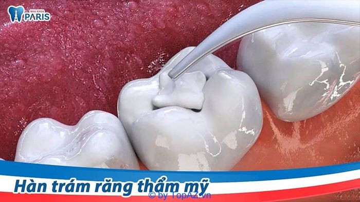 Địa chỉ trám răng uy tín và chất lượng nhất tại Hà Nội