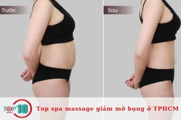 Địa chỉ vàng giảm mỡ bụng chuẩn y khoa tại Sài Gòn | Nguồn: VITA Clinic