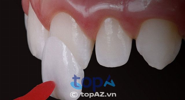 Trải nghiệm dán sứ Veneer tại Hà Nội: Đẹp tự nhiên, bền vững