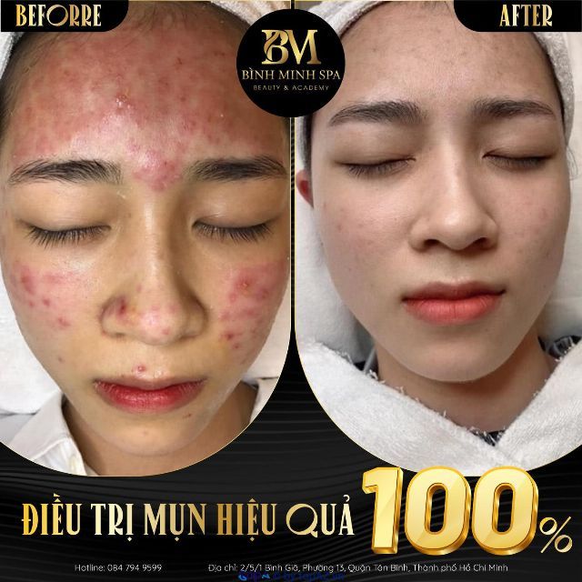 Bình Minh Spa - Chuyên gia trị mụn hàng đầu