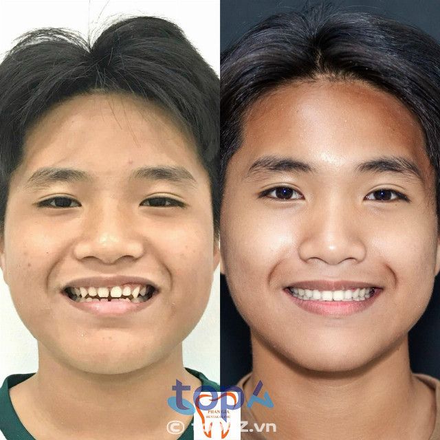 Địa chỉ niềng răng uy tín tại Rạch Giá