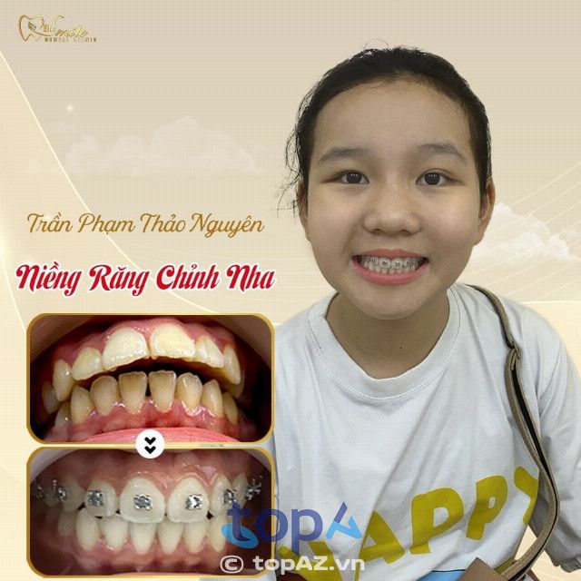 Tại Nha Khoa Dr Smile, mỗi kết quả niềng răng đều là một minh chứng cho sự thành công của quá trình điều trị, với nhiều khách hàng hài lòng và nụ cười rạng rỡ.