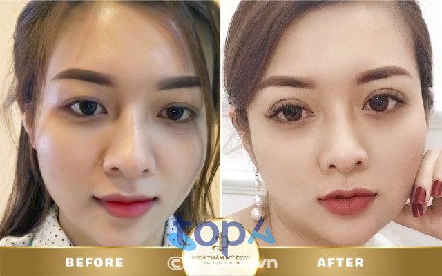 Các địa chỉ cắt mí mắt chất lượng tại TP. Mỹ Tho, Tiền Giang