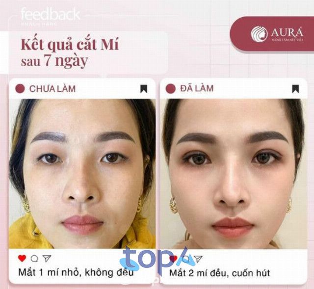 Địa chỉ cắt mí mắt uy tín tại TP. Mỹ Tho