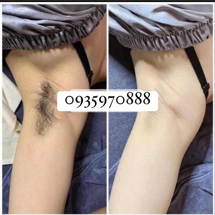 Hình ảnh thực tế về quy trình triệt lông chuyên nghiệp tại HANU Spa
