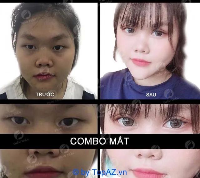 Kết quả cắt mí ấn tượng tại Viện thẩm mỹ Thảo Trần