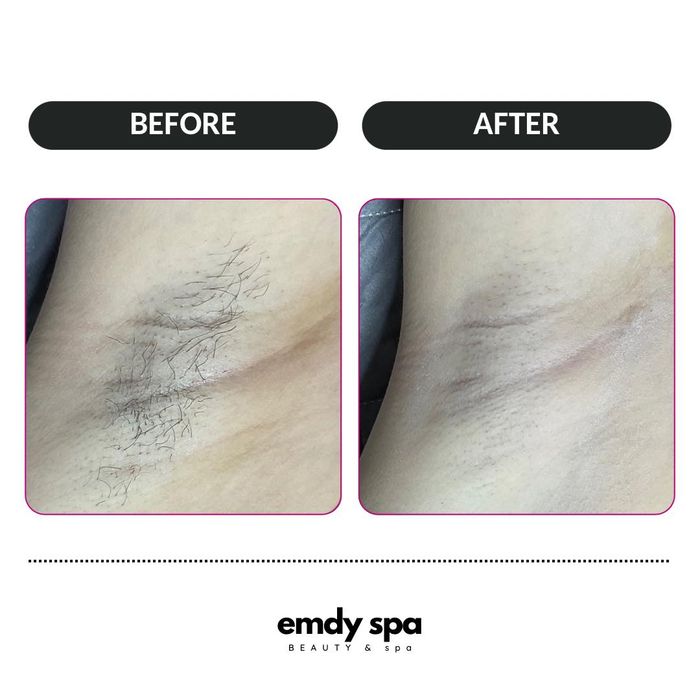 Hình ảnh quy trình triệt lông chuyên nghiệp tại Emdy Spa Quy Nhơn