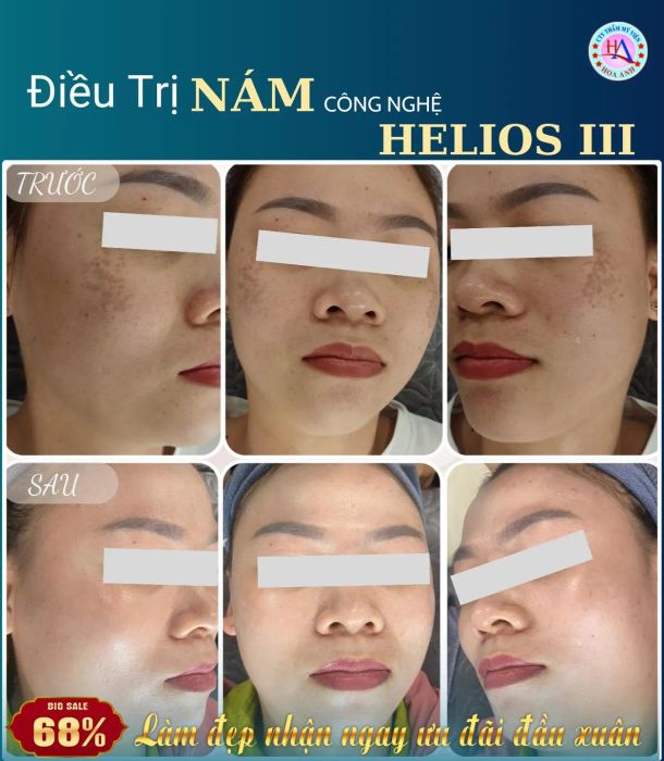 Hình ảnh phòng điều trị cao cấp tại Thẩm Mỹ Viện Hoa Anh