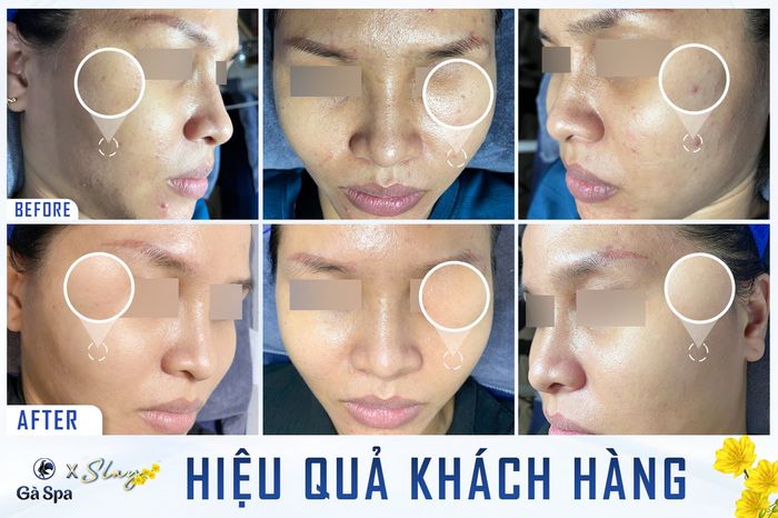 Không gian điều trị mụn chuyên nghiệp tại Gà Spa Thuận An
