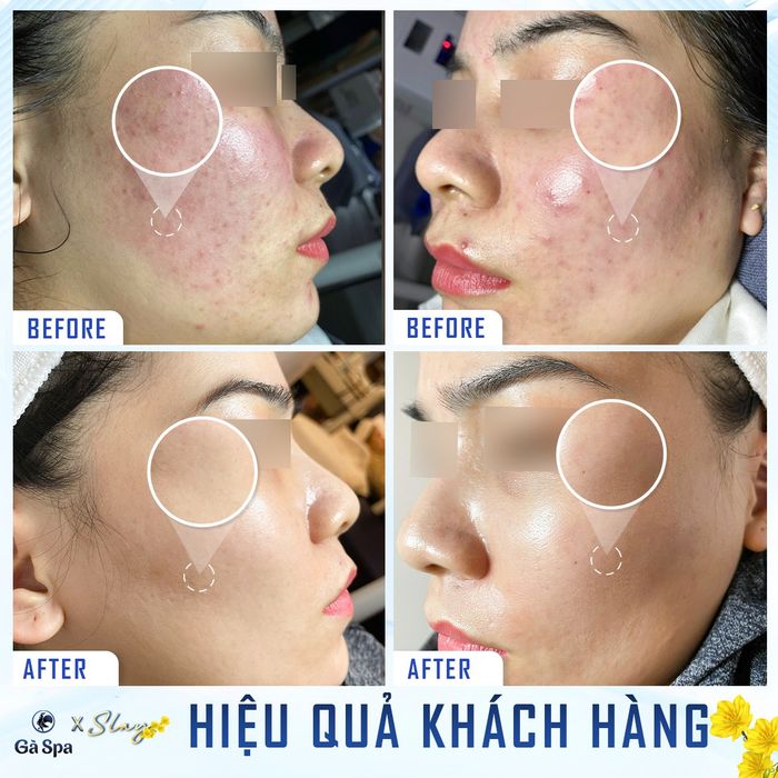 Quy trình điều trị mụn chuẩn y khoa tại Gà Spa Thuận An