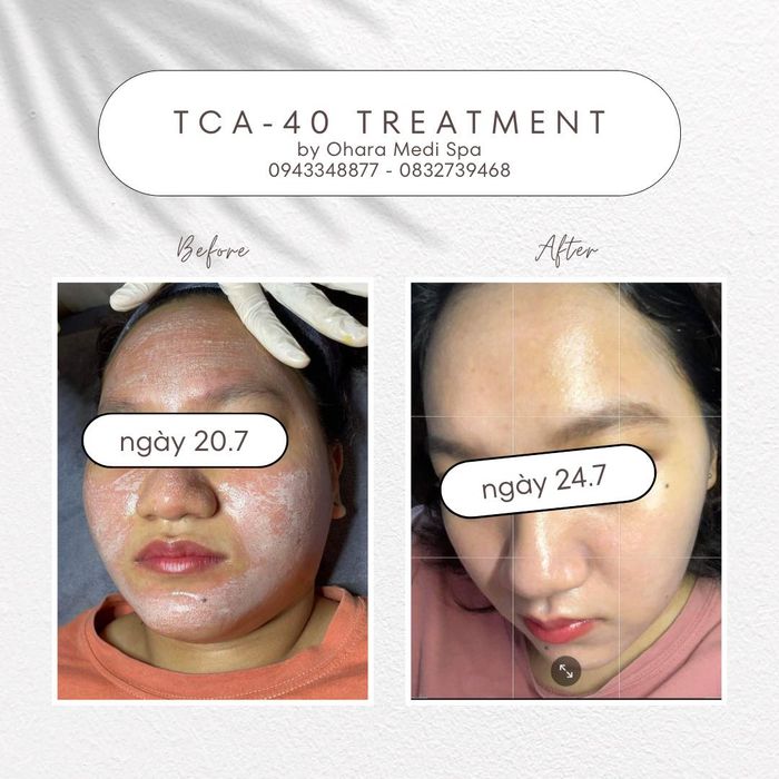 Ohara Beauty Spa ảnh 2 - Bộ sưu tập hình ảnh đắt giá minh chứng cho sự hoàn hảo trong từng liệu trình chăm sóc da.