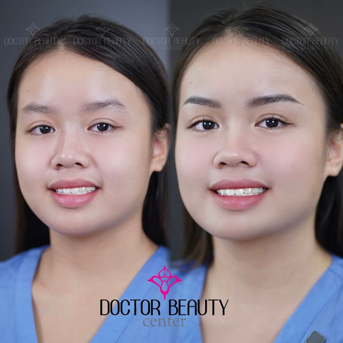 Hình ảnh thực tế về kết quả điêu khắc tại Doctor Beauty Center (ảnh 2)