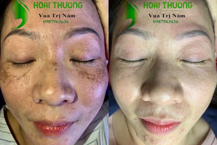 Không gian trị liệu sang trọng và hệ thống máy móc hiện đại tại Hoài Thương Spa