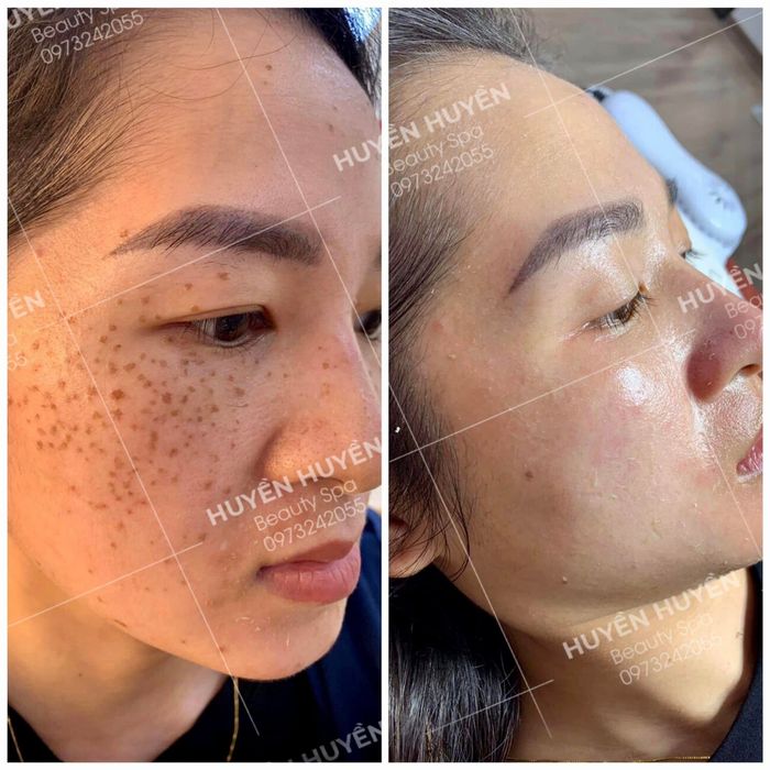 Hình ảnh thực tế về công nghệ trị nám đột phá tại Huyền Lady Spa