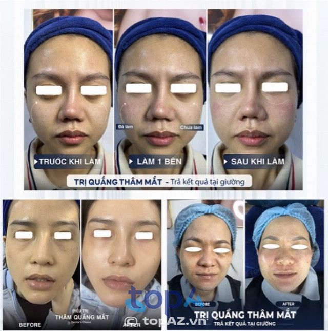 Dr. Choice Clinic tại Bình Thạnh, TPHCM, là địa chỉ tin cậy trong việc điều trị thâm quầng mắt, mang đến hiệu quả rõ rệt và an toàn cho mọi khách hàng.
