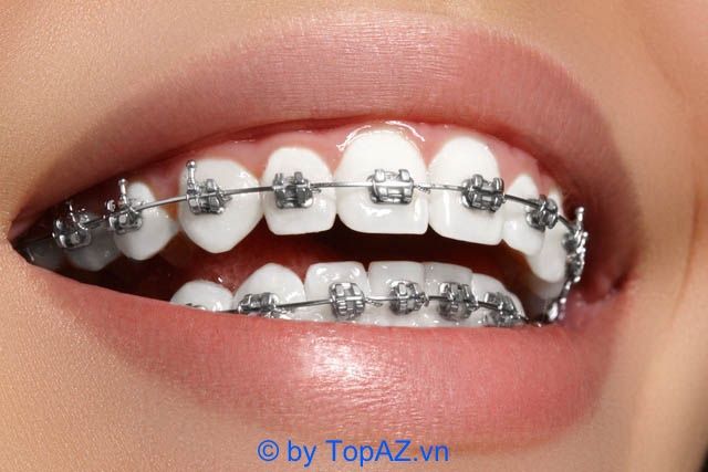 Top địa chỉ niềng răng chuẩn quốc tế tại TP Vinh, Nghệ An
