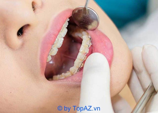 Địa chỉ vàng về niềng răng chất lượng tại thành phố Vinh, Nghệ An