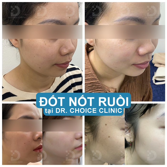 tay xoa not ruoi uy tin hcm.png